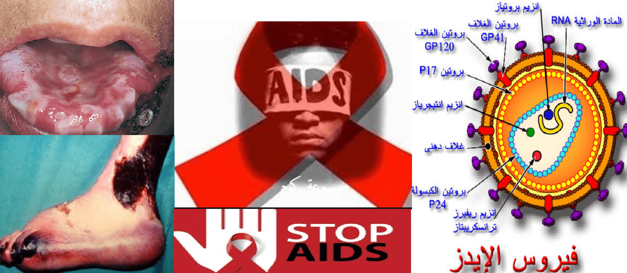 مرض السيدا اسبابه واعراضه وعلاجه