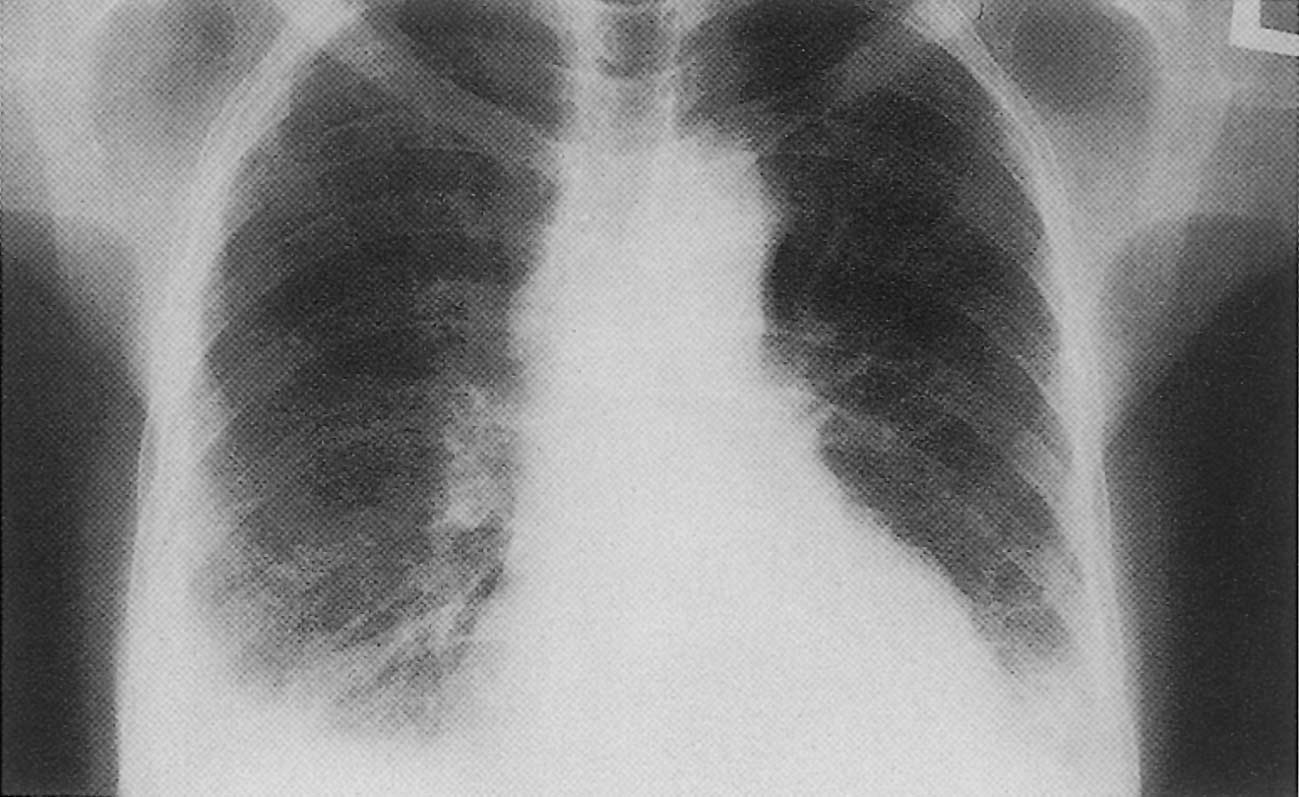 مياه على الرئة اعراضها واسبابها والوقاية منها