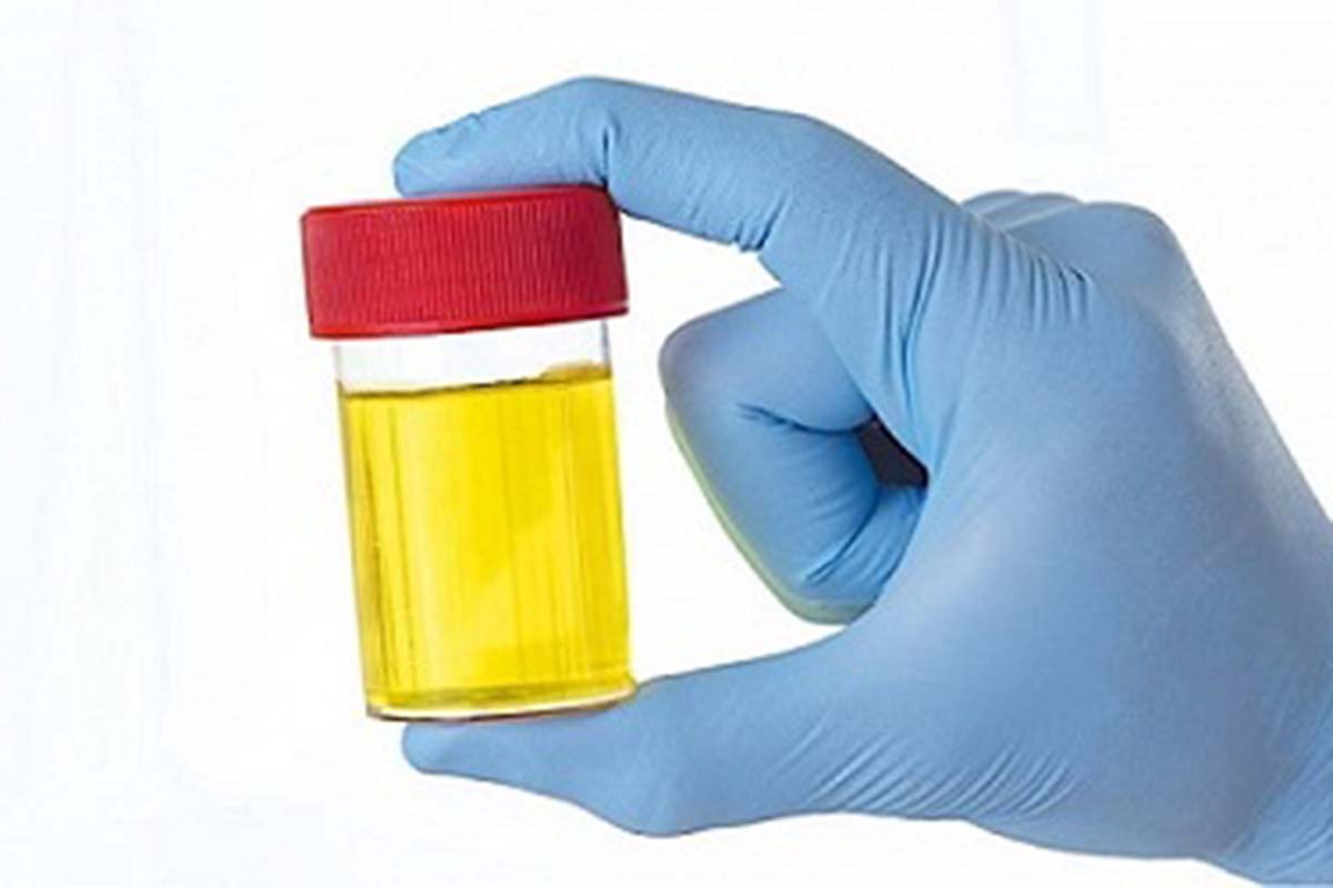 علاج الصديد والاملاح فى البول