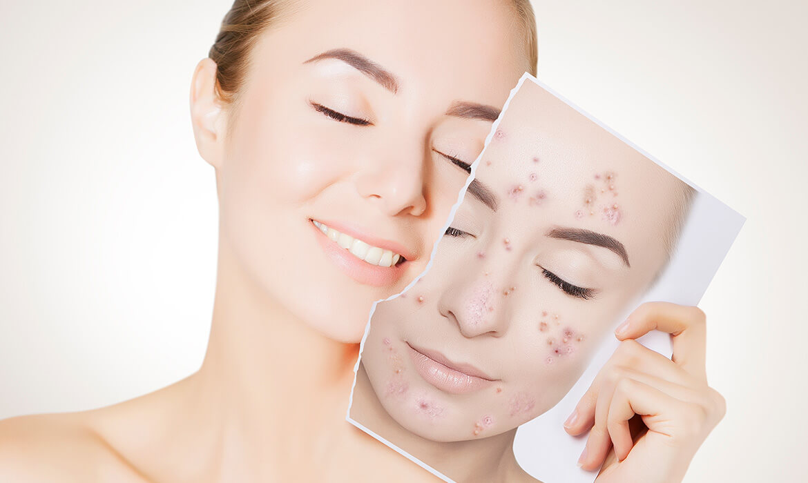 حب الشباب ماهي اعراضة وسبب ظهورة وعلاجة