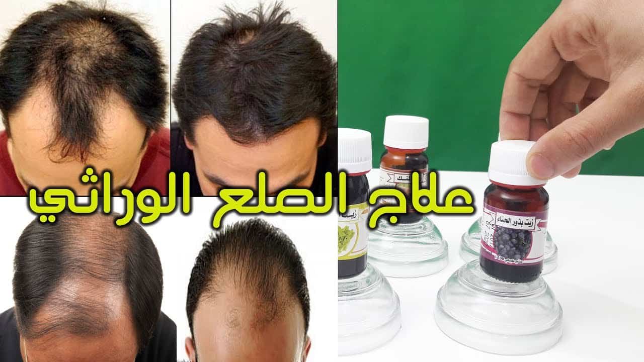 علاج الصلع المبكر