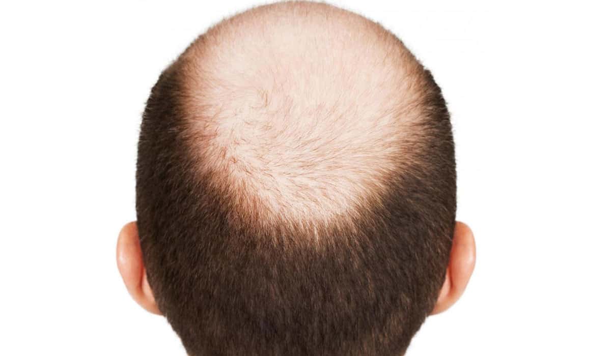 علاج الصلع بالأعشاب