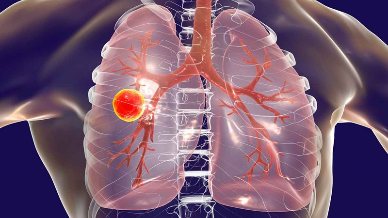 مرض السل اهم اسباب انتقاله واعراضه وعلاجه