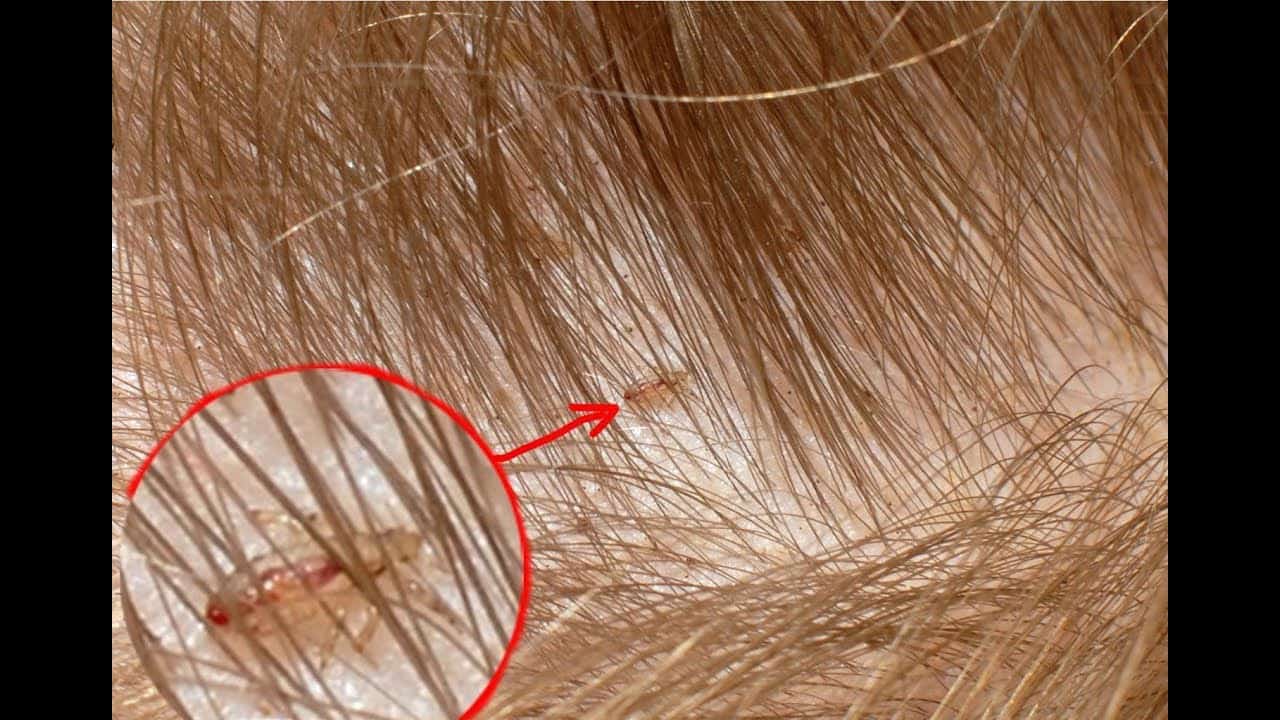 أفضل خلطه تروح القمل