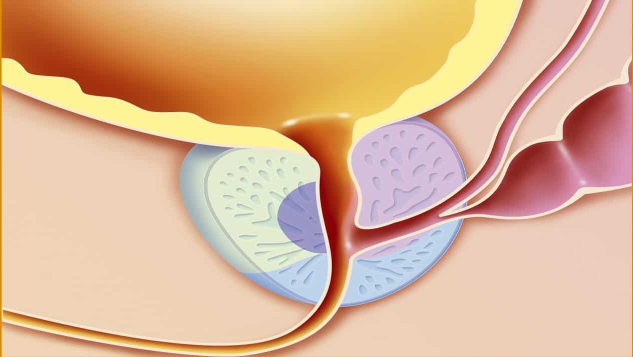 أعراض إحتقان البروستاتا المزمن