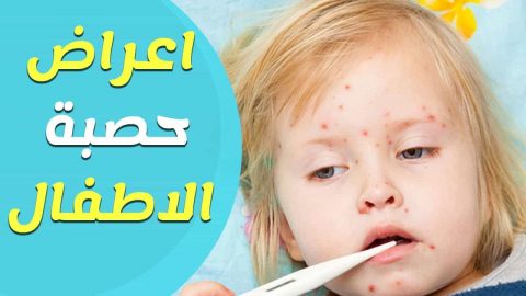 اعراض الحصبة عند الاطفال وعلاجها والوقايه منها