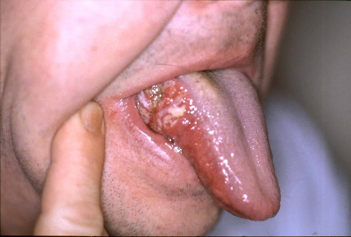 أعراض مرض erythroplakia “سرطان الفم”
