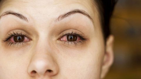 أعراض حساسية العين من الضوء وعلاجها