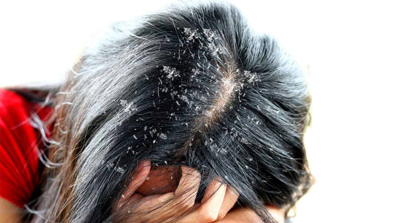  علاج seborrheic dermatitis