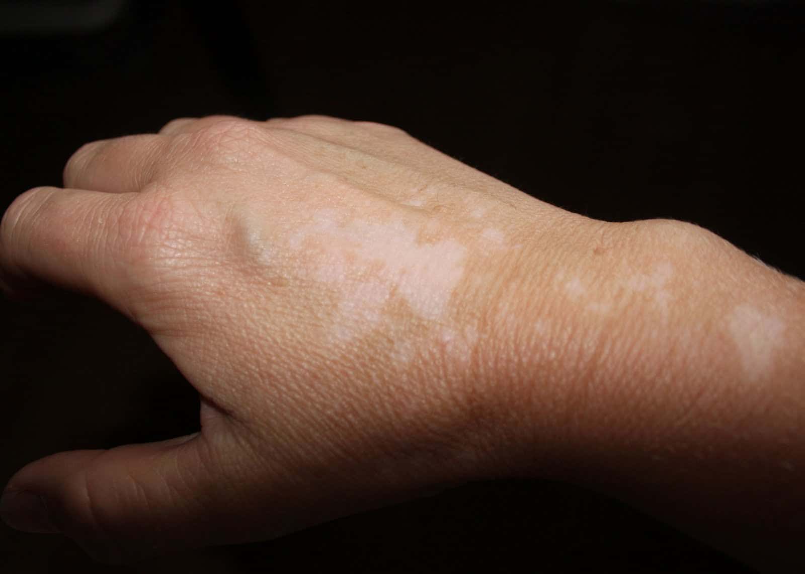 كريم امودين أفضل كريمات علاج البهاق”Amodine”