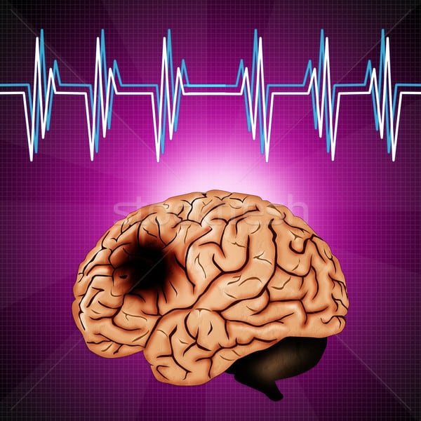 اسباب سرطان المخ واعراضه وتشخيصه