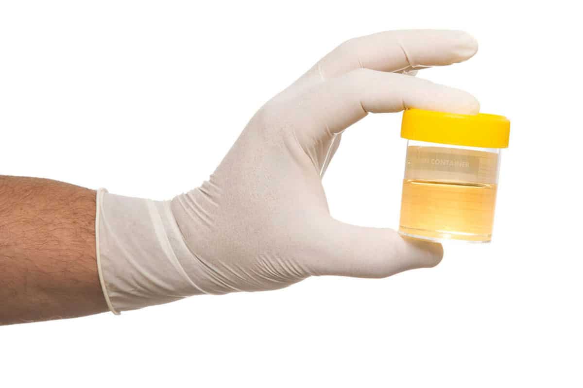 سبب وجود نسبة دم في البول