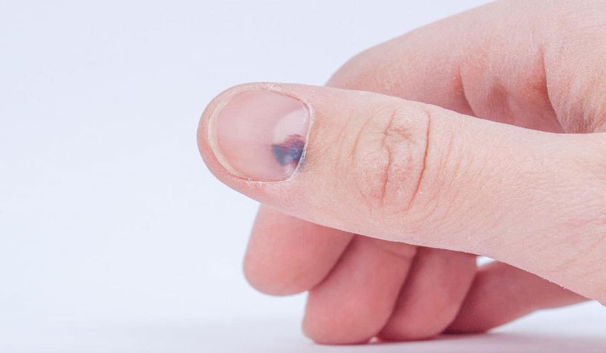 علاج الإصبع المدوحس