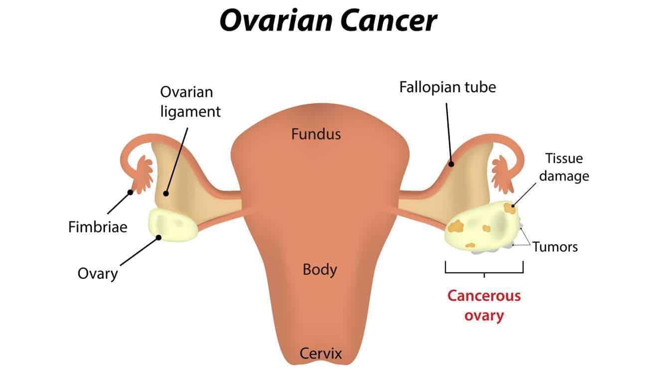 أعراض سرطان المبيض الخبيث