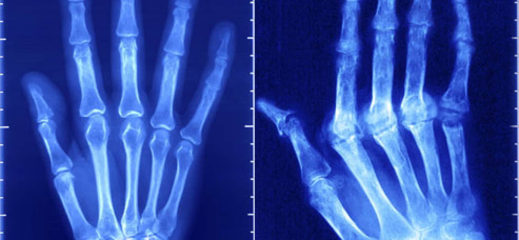 أعراض إلتهاب المفاصل الرثوي واسبابه وعلاجه