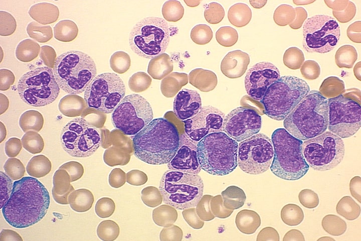 ما هو سبب وعلاج ارتفاع neutrophils في الدم ؟