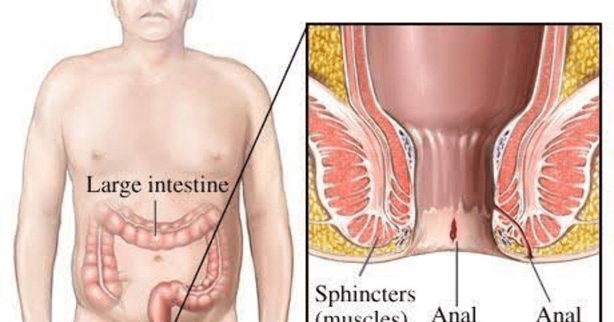 ما علاج الشرخ الشرجي ؟