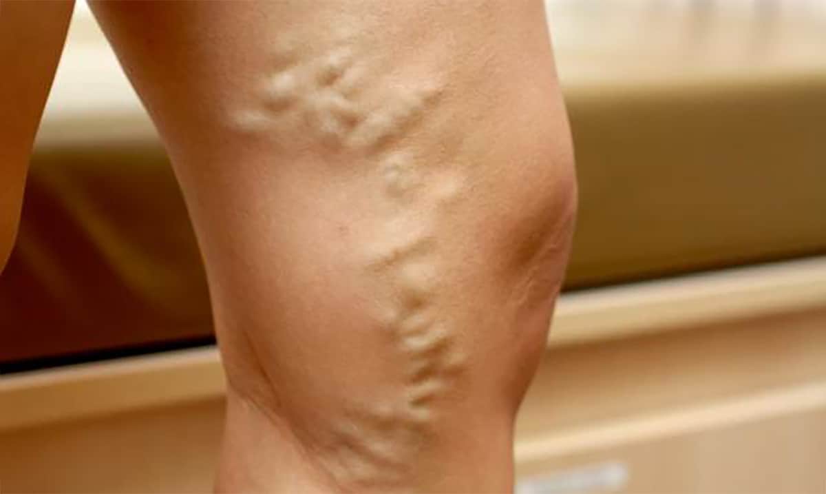 ما طريقة علاج الدوالي بالأعشاب ؟
