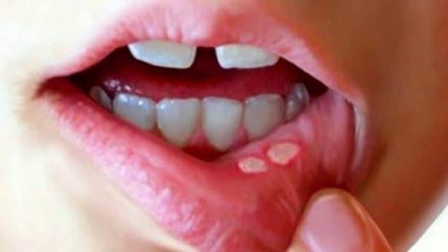 ما هي اسباب قرح الفم وعلاجها ؟