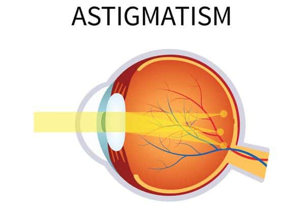 سبب الإستجماتيزم واعراضه وعلاجه