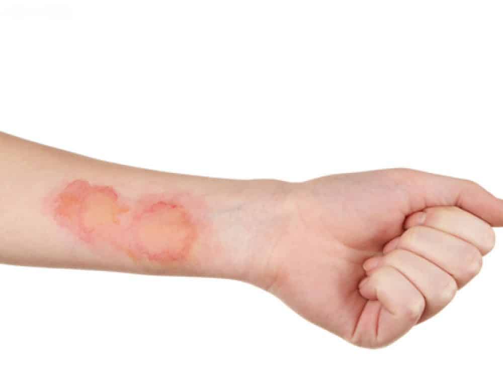 تفسير الحرق في الحلم لابن سيرين