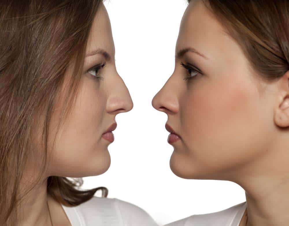 علاج إنحراف الأنف بدون عملية