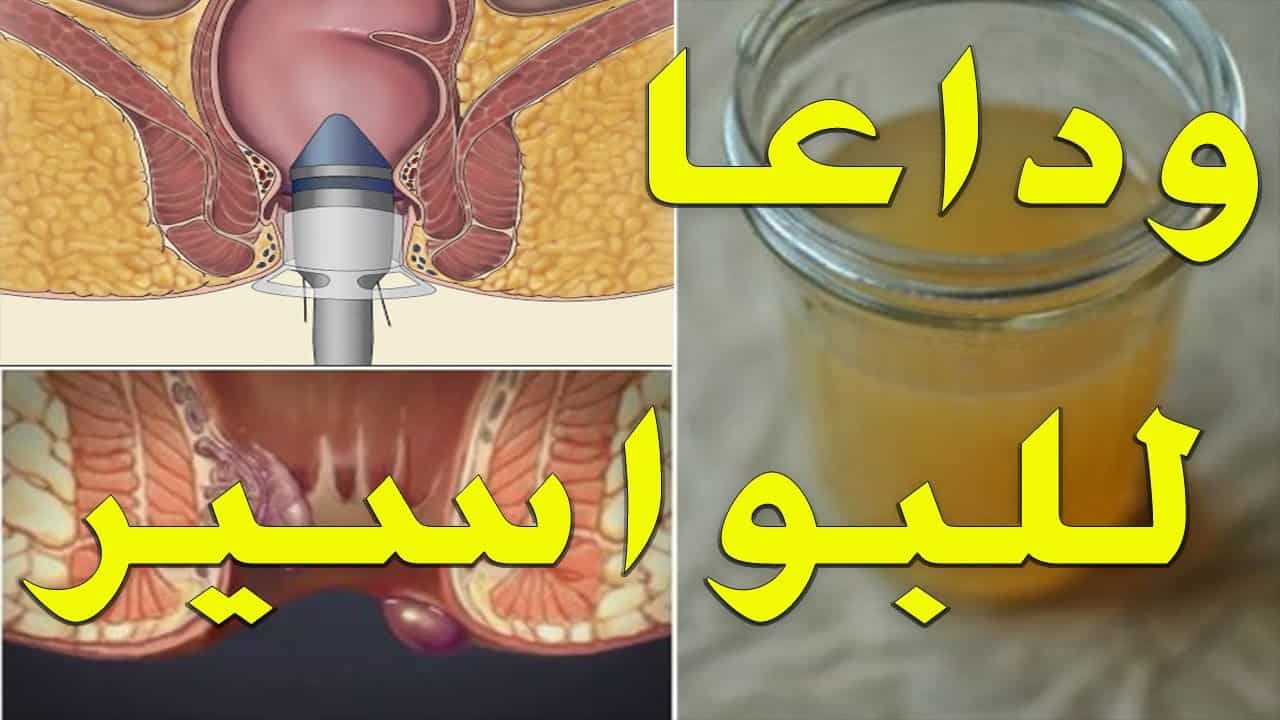 ادوية البواسير الداخلية – أفضل ادوية علاج البواسير