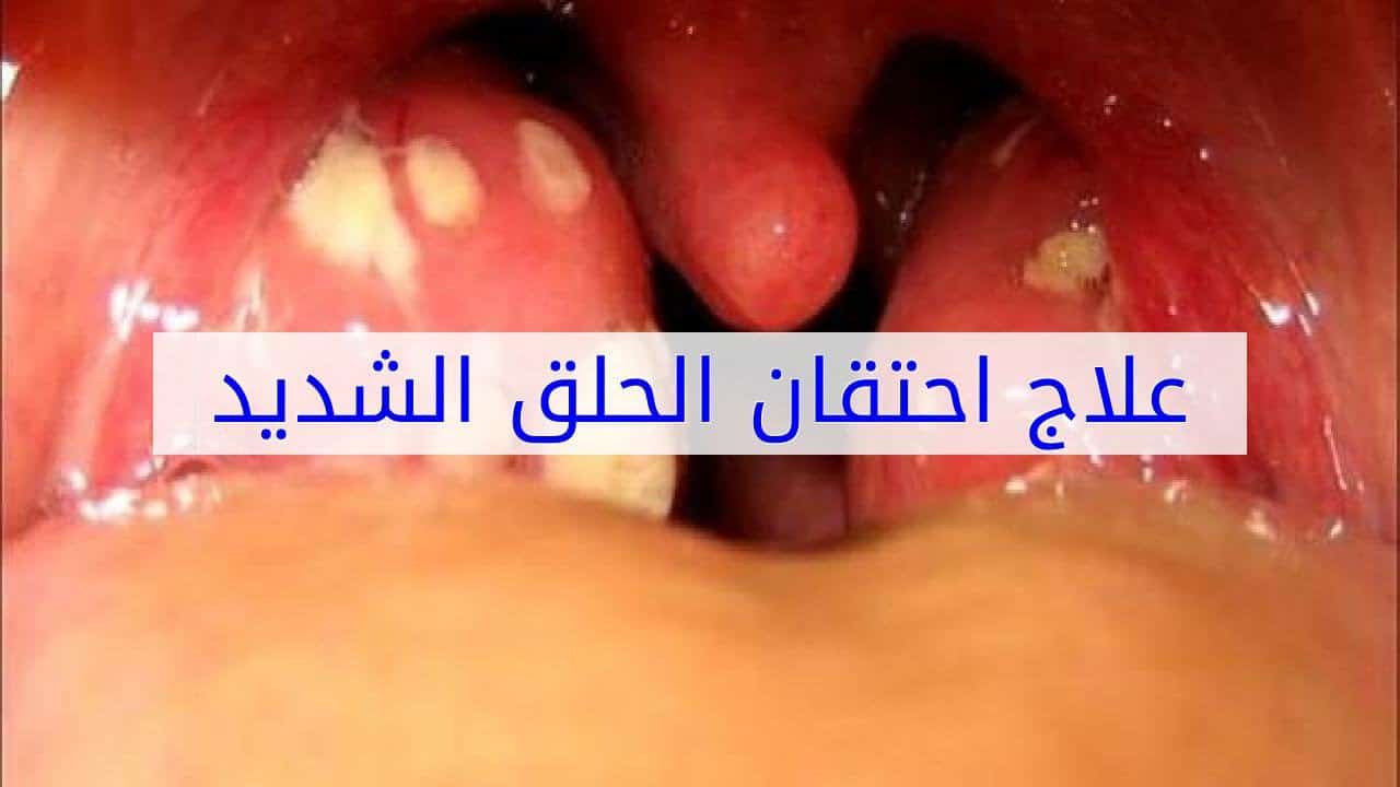 أفضل ادوية علاج احتقان الزور سريعة المفعول