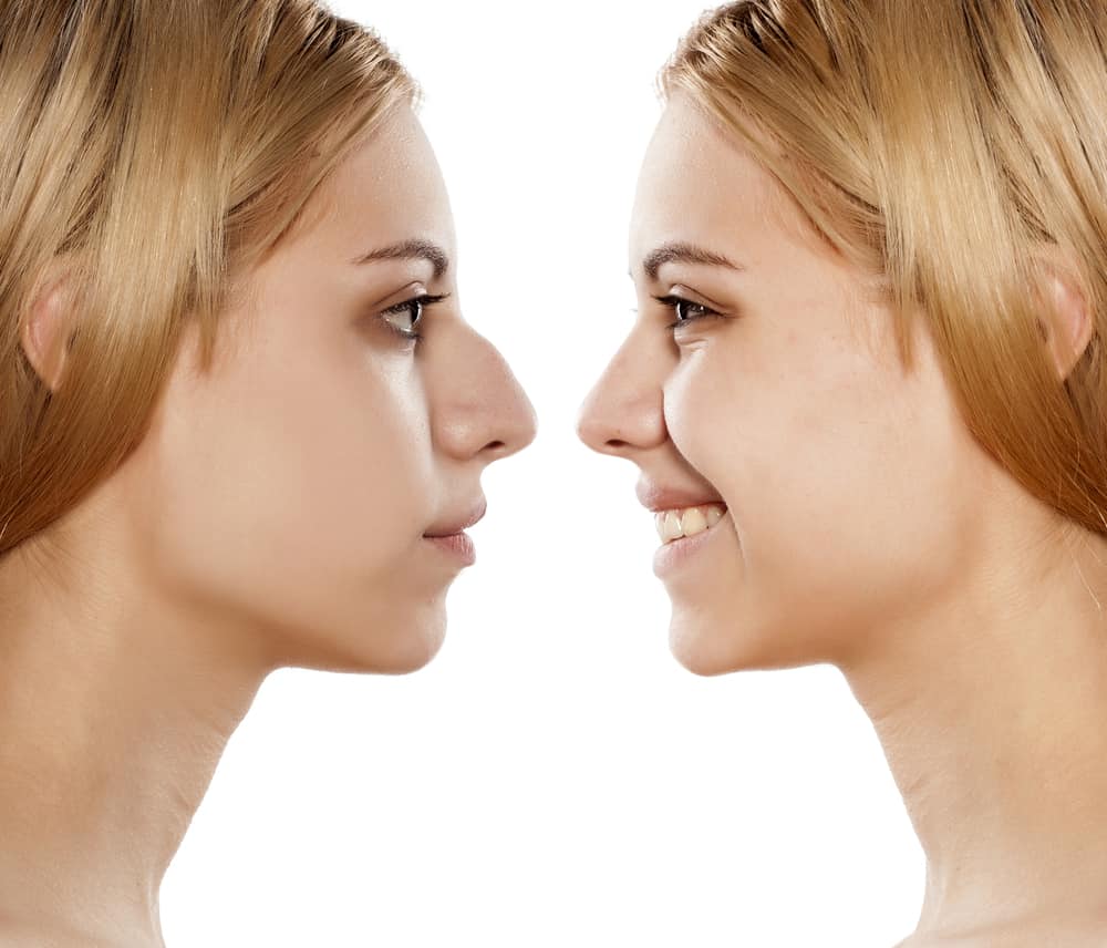 علاج انحراف الحاجز الأنفي واعراضة