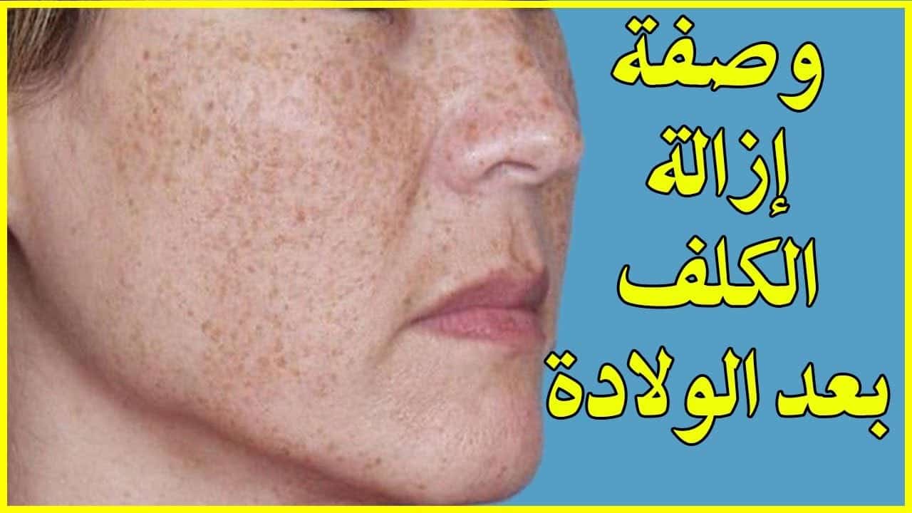 سبب واماكن ظهور الكلف اثناء الحمل وعلاجه مضمون