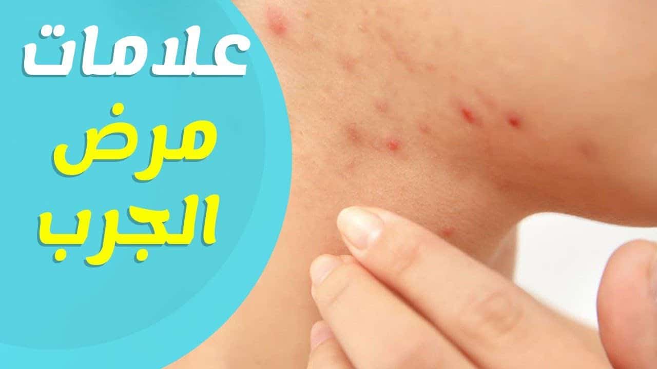 كيفية علاج الجرب عند الأطفال ؟
