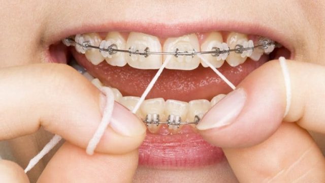ما هي مدة تقويم الأسنان  ؟