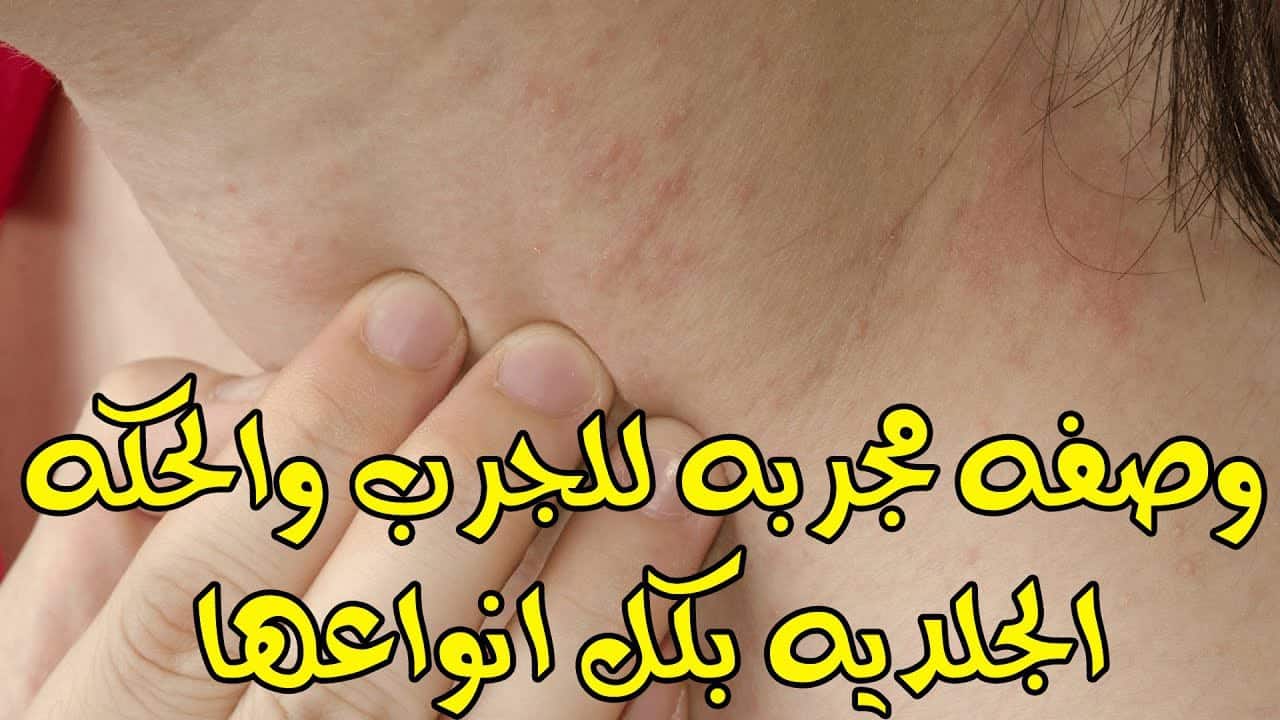 علاج الجرب بالأعشاب والطب البديل