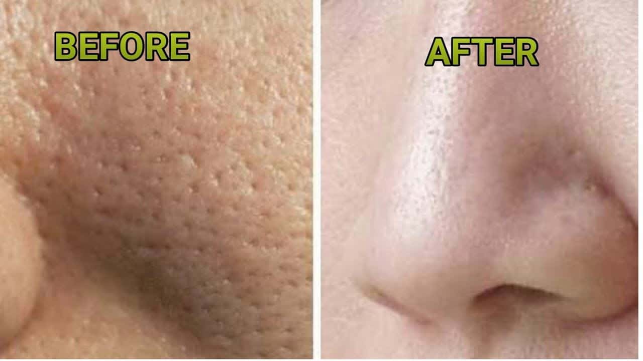 كيفية تضييق المسام في البشرة ؟
