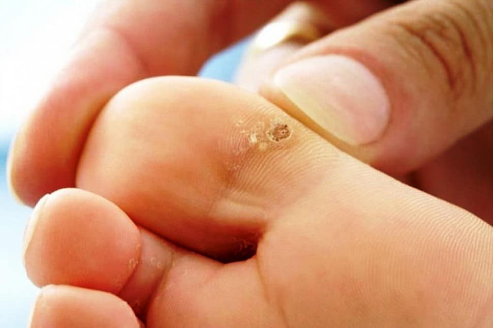 علاج عين السمكة في الإصبع وسببها