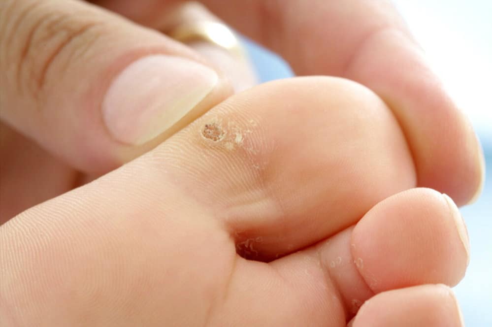 علاج عين السمكة في المنزل