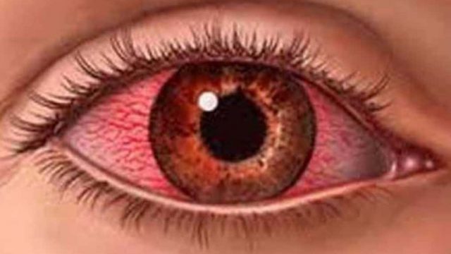 احمرار العين – الأسباب – العلاج
