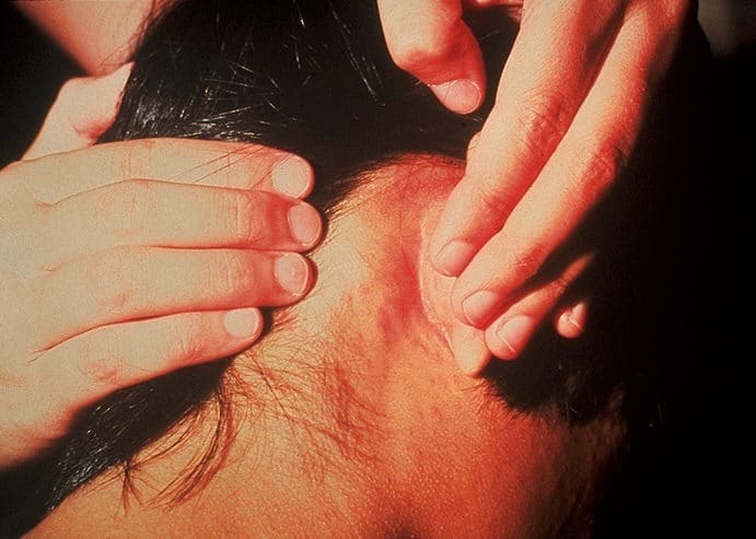سبب ظهور حبايه وراء الأذن