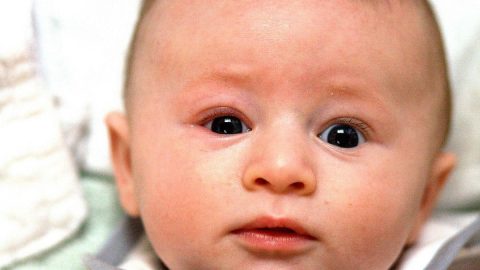علاج التهاب العين عند الاطفال الرضع