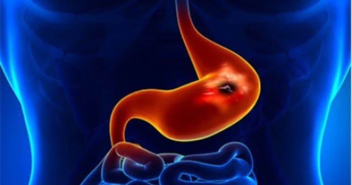 ما هي أعراض التهاب المعدة وعلاجها ؟