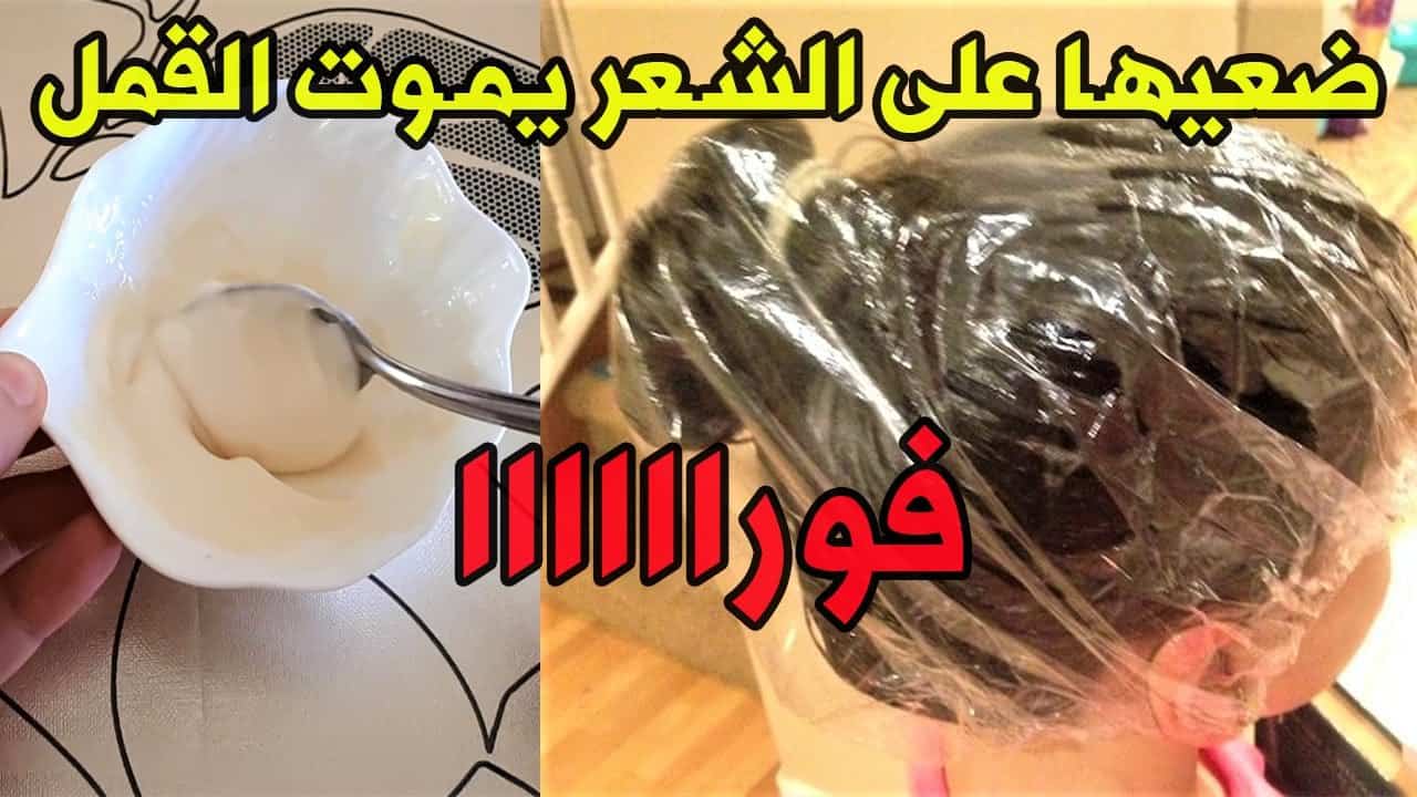 علاج القمل والصيبان من أول مره