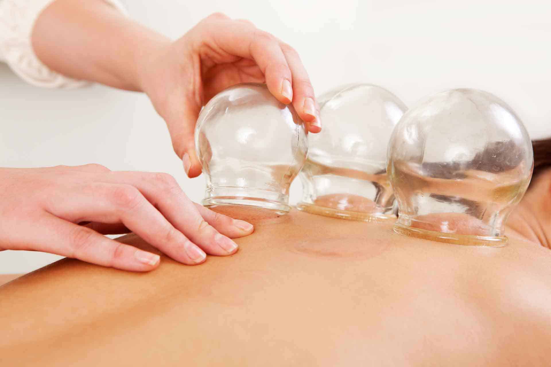 تجارب الحجامة المتزحلقة للحمل وعلاج العقم