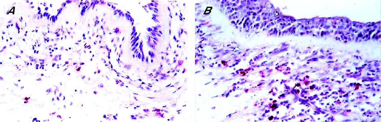 ما هي اسباب ارتفاع النيتروفيل كثرة العدلات