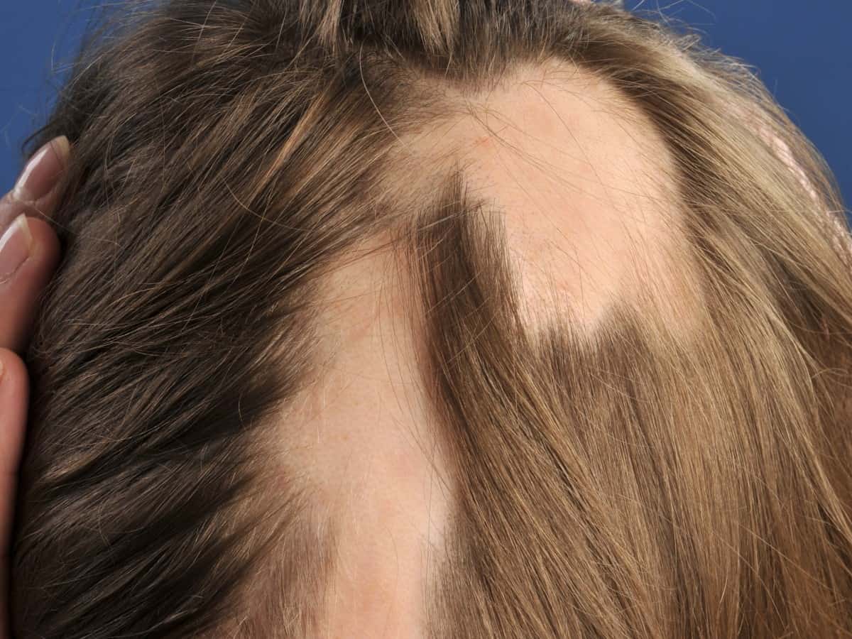 افضل علاج للثعلبة