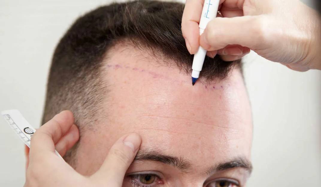 تجربتي لزراعة الشعر في تركيانا