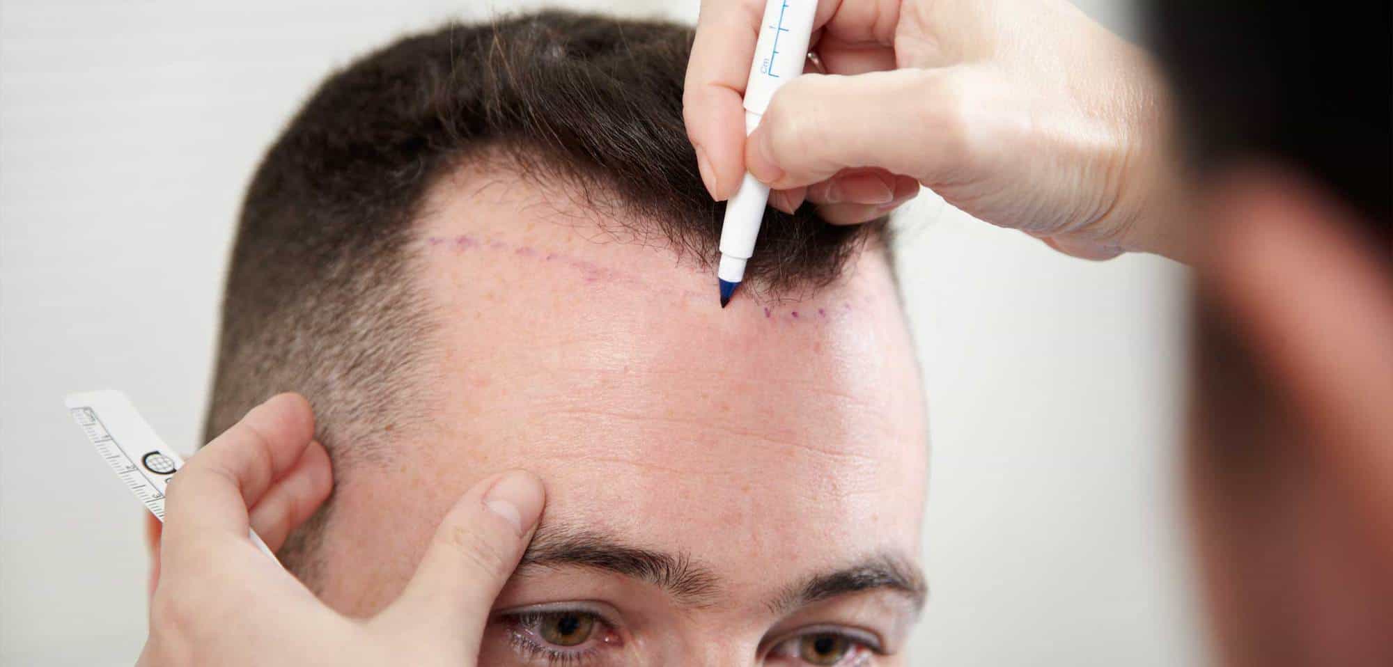 تجربة زراعة الشعر في جدة للرجال والنساء مع الأسعار
