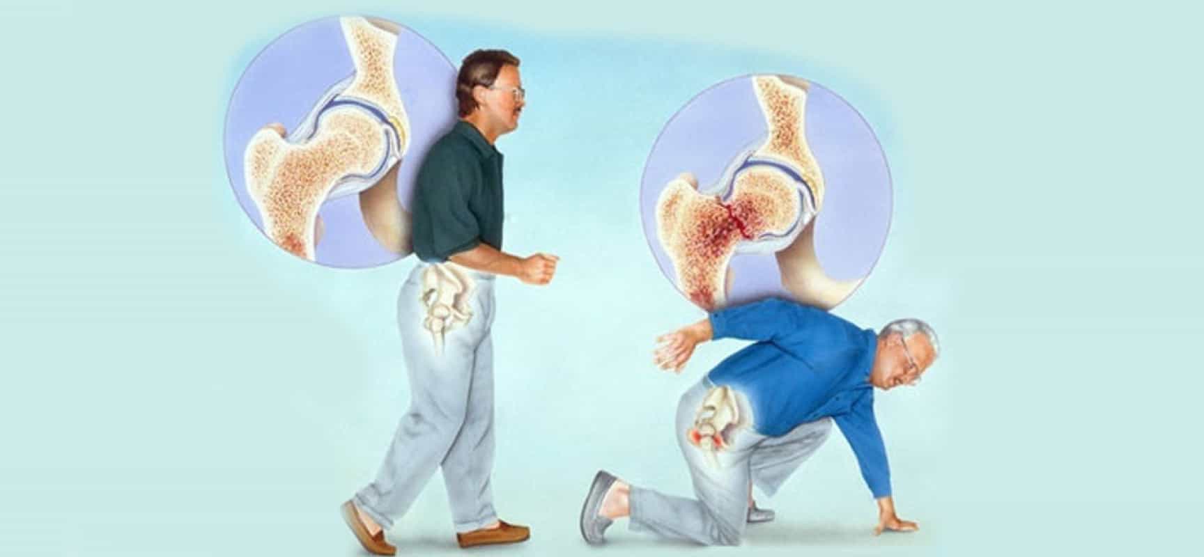 صور عن هشاشة العظام