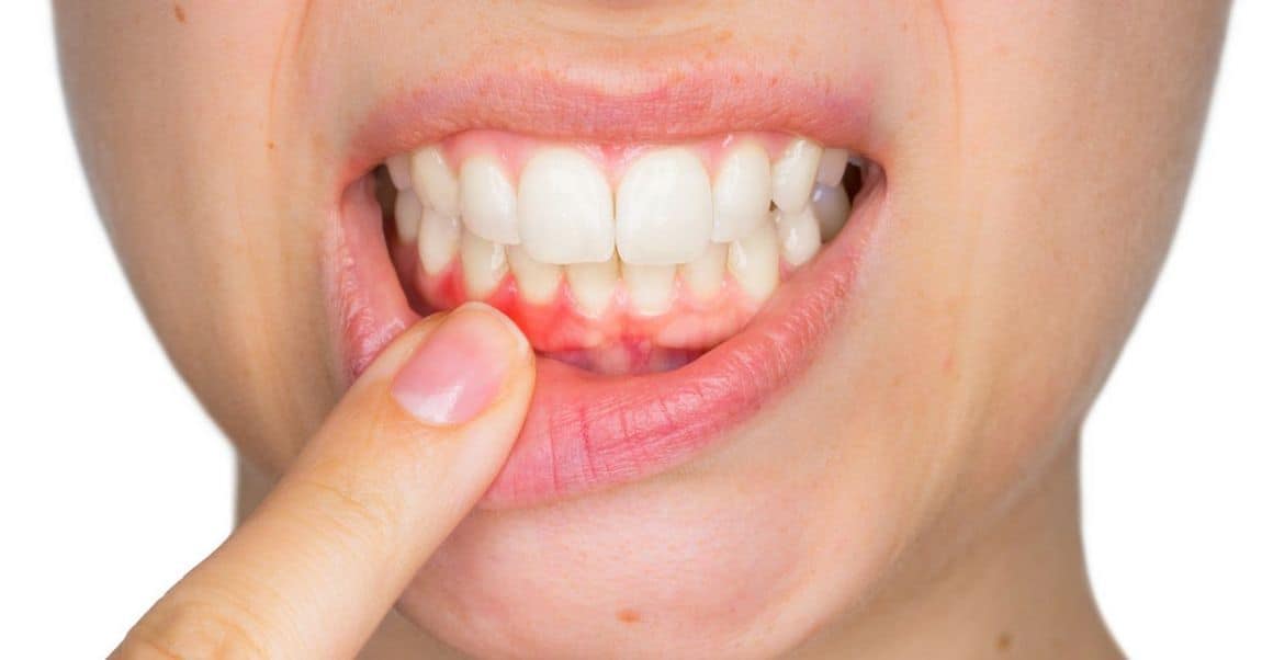 علاج التهاب اللثة طبيعي مجرب