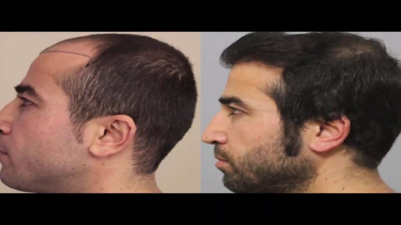 معلومات عن دكتور محمد جوتشلو في زراعة الشعر بتركيا