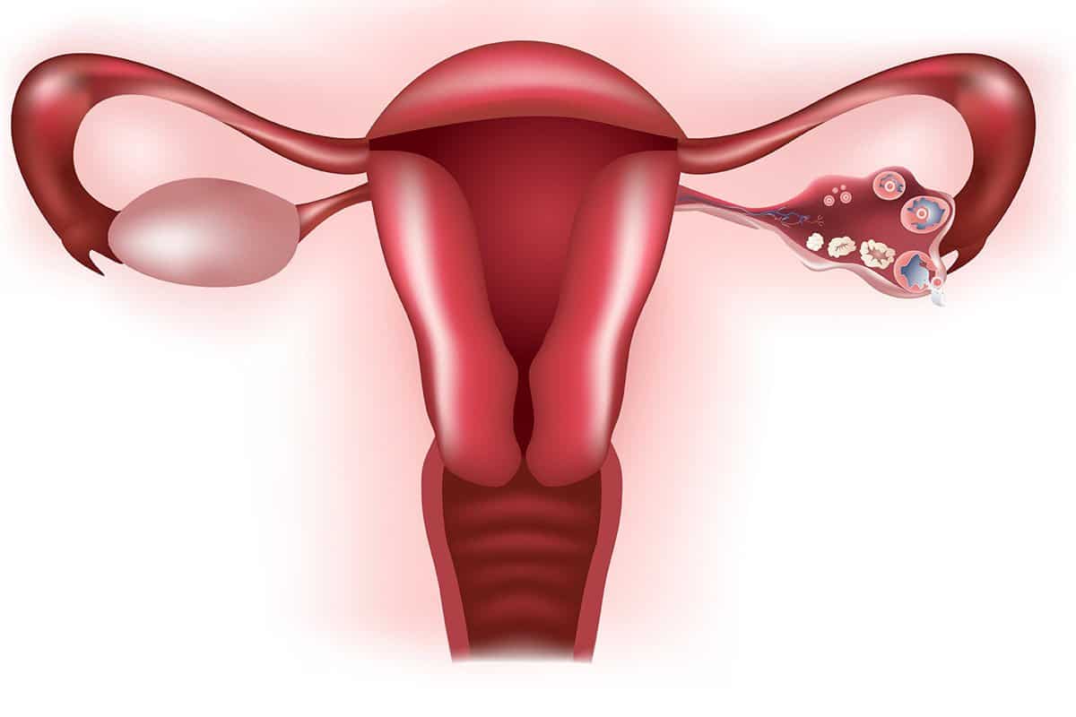 كيفية علاج تكيس المبايض بالاعشاب